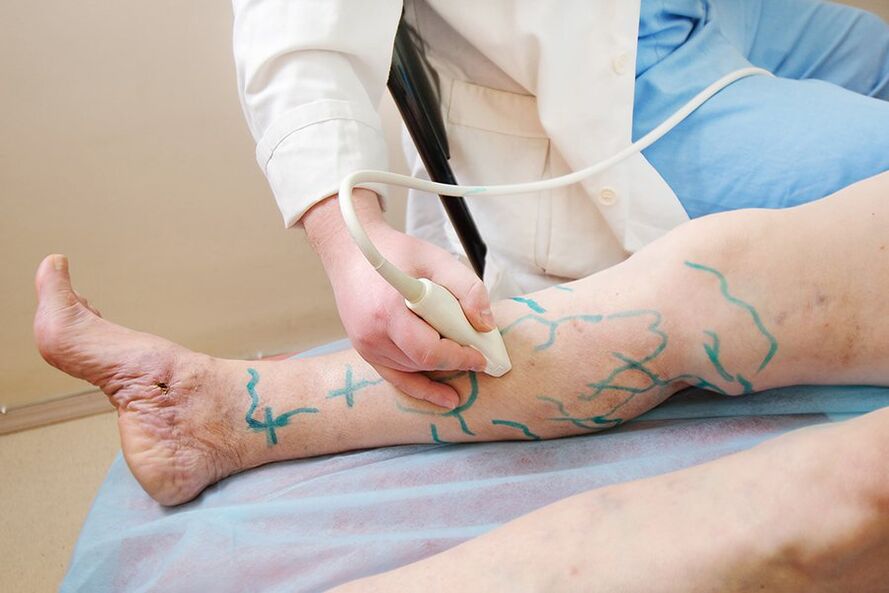 Përgatitja për miniflebektomi - shënimi në perforuesit e këmbës së poshtme, kryerja e ultrasonografisë